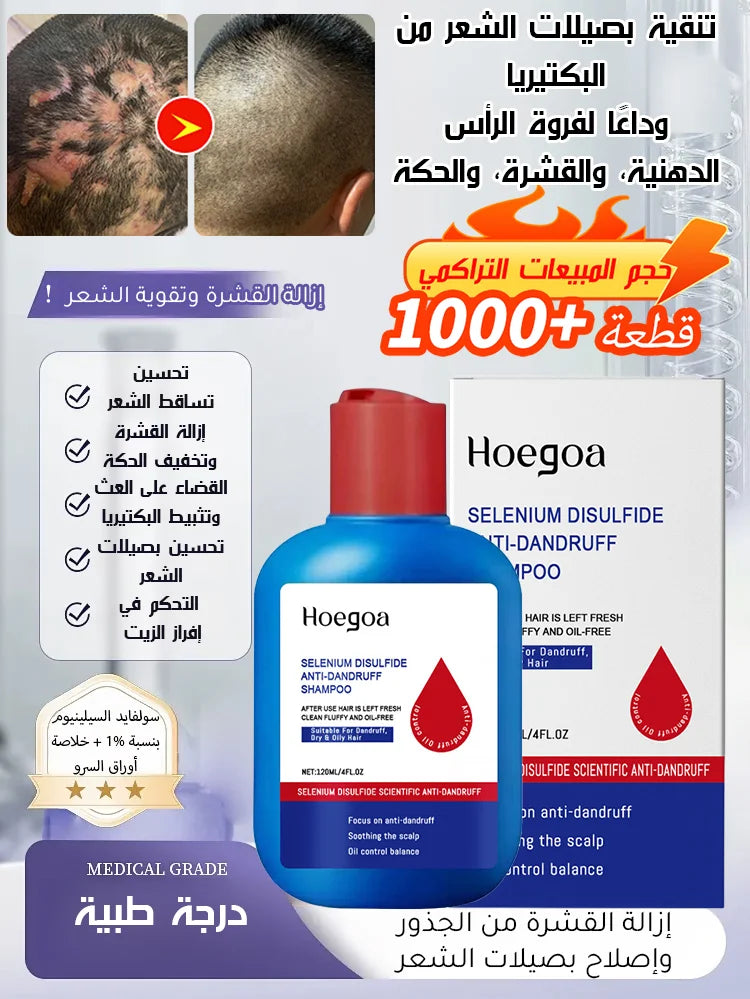 【التخلص من سعفة فروة الرأس العنيدة في 3 أسابيع】شامبو طبي مضاد للبكتيريا والعث